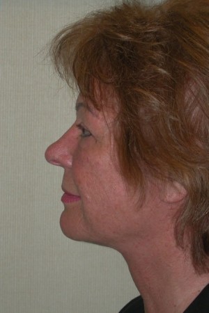 Facelift and Necklift Case 5219 After Photo Facelift and Necklift