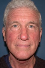 Facelift and Necklift