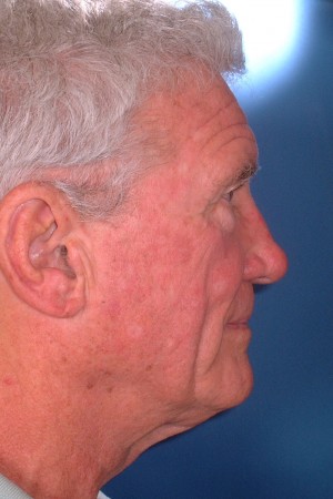 Facelift and Necklift Case 5241 Before Photo Facelift and Necklift
