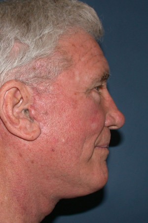 Facelift and Necklift Case 5241 After Photo Facelift and Necklift