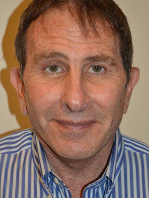 Facelift and Necklift Case 5283 After Photo Facelift and Necklift