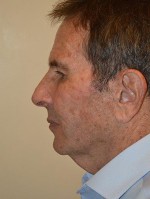 Facelift and Necklift