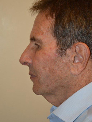 Facelift and Necklift Case 5283 Before Photo Facelift and Necklift