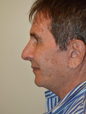 Facelift and Necklift Case 5283 After Photo Facelift and Necklift