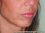 Facial Fat Grafting