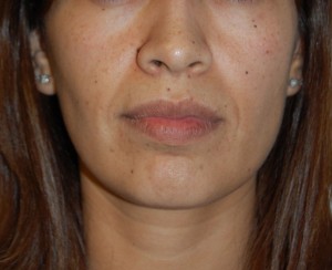 Facial Fat Grafting Case 5490 Before Photo Facial Fat Grafting