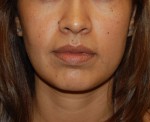 Facial Fat Grafting