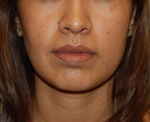 Facial Fat Grafting Case 5490 After Photo Facial Fat Grafting