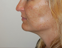 Injectable Fillers