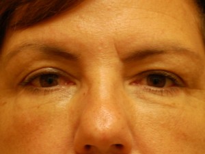 Injectable Fillers Case 5552 After Photo Injectable Fillers