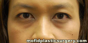 Injectable Fillers Case 5582 Before Photo Injectable Fillers