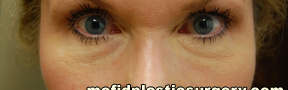 Injectable Fillers Case 5588 After Photo Injectable Fillers