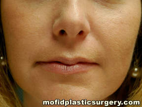 Injectable Fillers