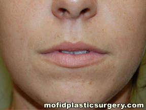 Injectable Fillers