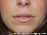 Injectable Fillers