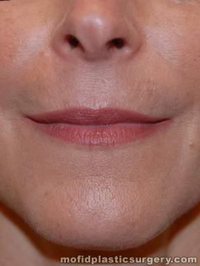 Injectable Fillers Case 5622 After Photo Injectable Fillers