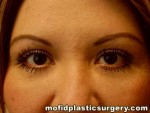 Injectable Fillers