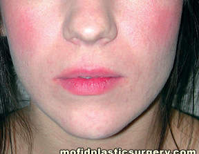 Injectable Fillers Case 5636 Before Photo Injectable Fillers