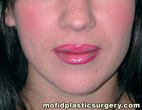 Injectable Fillers Case 5636 After Photo Injectable Fillers