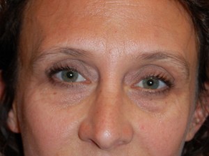 Injectable Fillers Case 5648 Before Photo Injectable Fillers