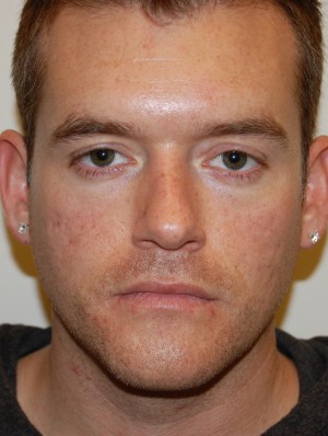 Injectable Fillers Case 5654 Before Photo Injectable Fillers