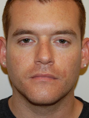 Injectable Fillers Case 5654 After Photo Injectable Fillers