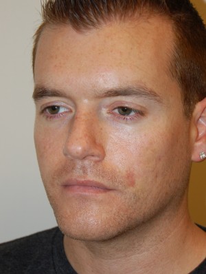 Injectable Fillers Case 5654 After Photo Injectable Fillers
