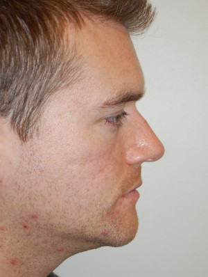 Injectable Fillers Case 5654 Before Photo Injectable Fillers
