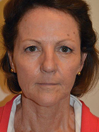 Laser, Chemical Peels & Dermabrasion Case 5499 Before Photo Laser, Chemical Peels & Dermabrasion