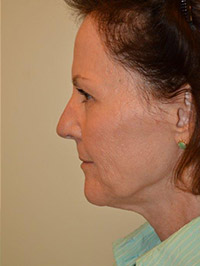 Laser, Chemical Peels & Dermabrasion Case 5499 After Photo Laser, Chemical Peels & Dermabrasion
