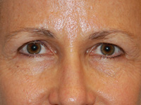 Laser, Chemical Peels & Dermabrasion