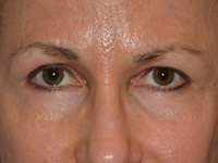 Laser, Chemical Peels & Dermabrasion