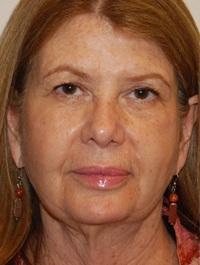 Laser, Chemical Peels & Dermabrasion Case 5541 After Photo Laser, Chemical Peels & Dermabrasion