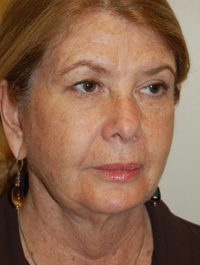 Laser, Chemical Peels & Dermabrasion Case 5541 Before Photo Laser, Chemical Peels & Dermabrasion