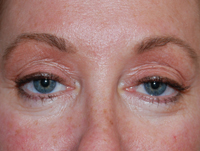 Laser, Chemical Peels & Dermabrasion Case 5566 Before Photo Laser, Chemical Peels & Dermabrasion