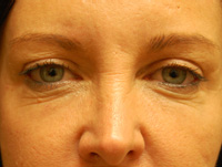Laser, Chemical Peels & Dermabrasion Case 5574 Before Photo Laser, Chemical Peels & Dermabrasion