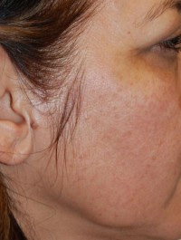 Laser, Chemical Peels & Dermabrasion Case 5613 Before Photo Laser, Chemical Peels & Dermabrasion