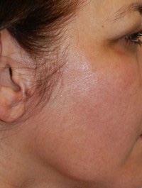 Laser, Chemical Peels & Dermabrasion Case 5613 After Photo Laser, Chemical Peels & Dermabrasion