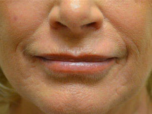 Lip Augmentation