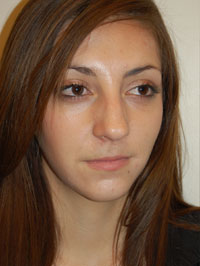 Lip Augmentation Case 5199 Before Photo Lip Augmentation