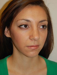 Lip Augmentation Case 5199 After Photo Lip Augmentation