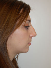 Lip Augmentation Case 5199 Before Photo Lip Augmentation