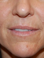 Lip Augmentation