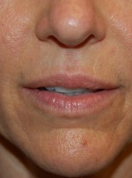 Lip Augmentation