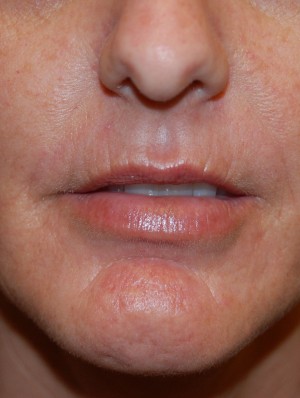 Lip Augmentation Case 5217 Before Photo Lip Augmentation