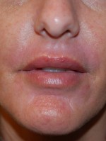 Lip Augmentation