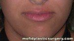 Lip Augmentation