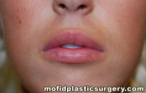 Lip Augmentation Case 5239 After Photo Lip Augmentation
