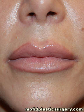 Lip Augmentation Case 5278 After Photo Lip Augmentation