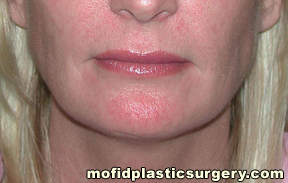 Lip Augmentation Case 5286 After Photo Lip Augmentation